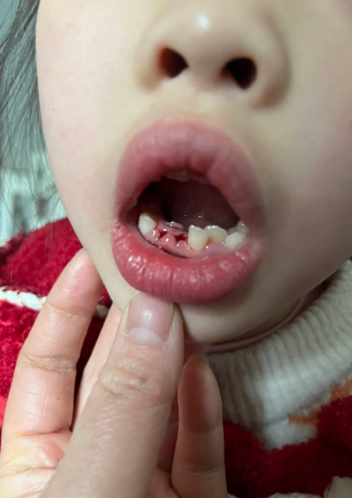 醫生誤判將女孩恒牙當乳牙拔掉 科普：恒牙和乳牙區別